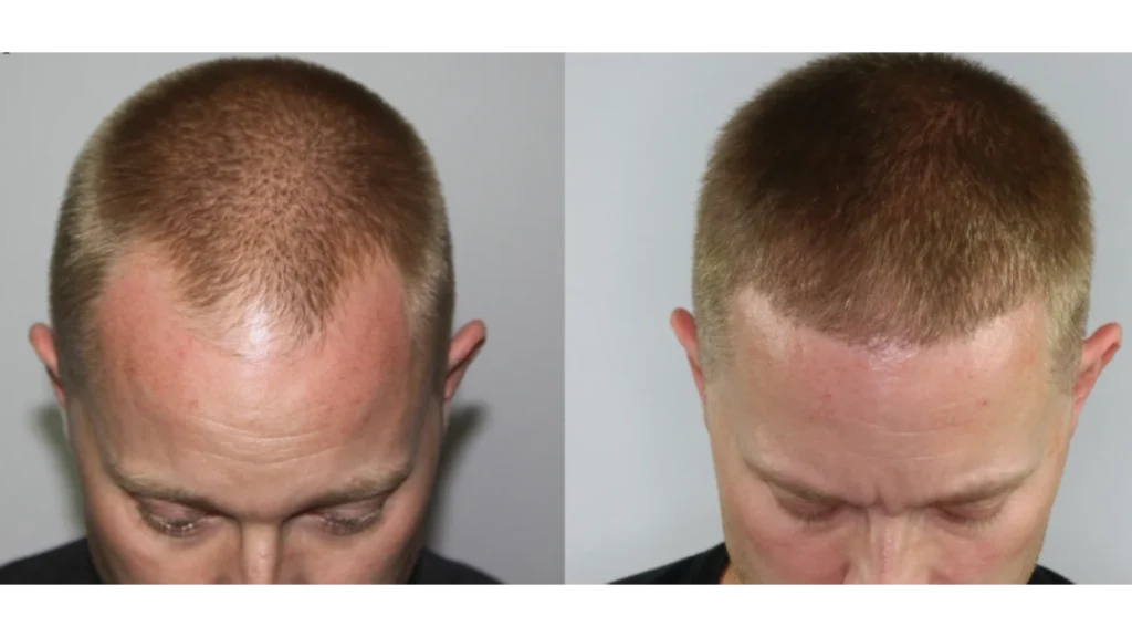 thin hair transplant