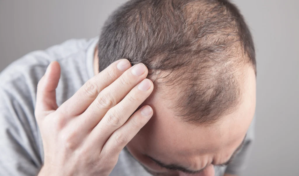 best candidate for a-hair transplant