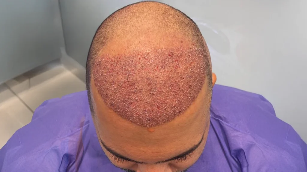 متی تثبت البصیلات بعد زراعة الشعر