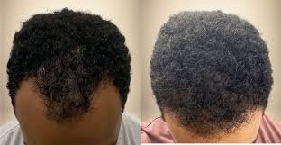 Afro Hair Transplant for Black Men