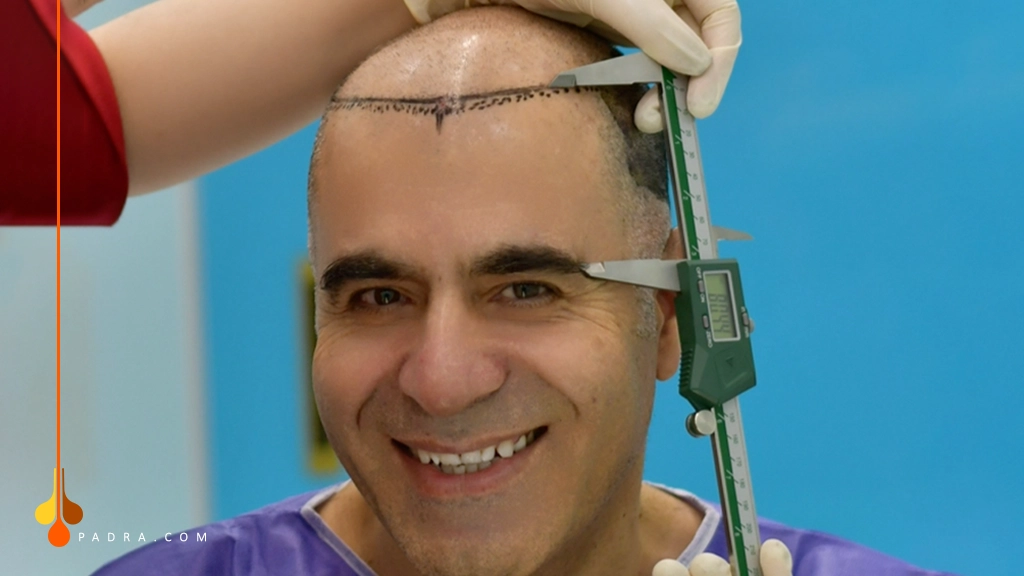 temple hairline design